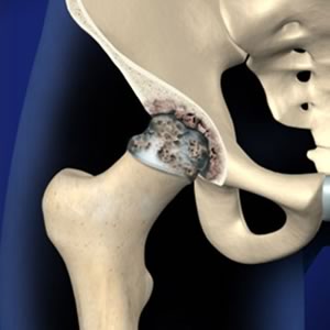 anim img Hip Osteoarthritis