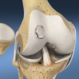 ACL Tear