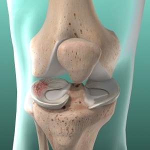 Meniscus Tear