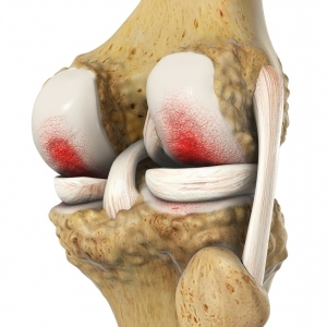 Knee Osteoarthritis