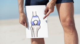 knee replacement drawing
