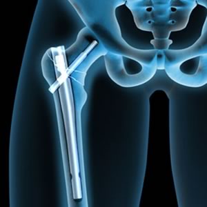 anim img Femur Fracture Fixation