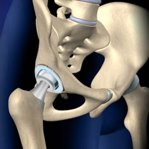 anim img Hip Replacement Anterior