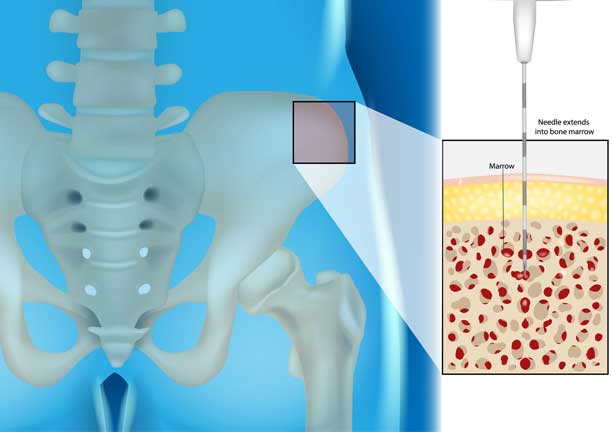 Bone Marrow Aspirate Cell ConcentrateTreatment