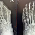 Bunion Surgery