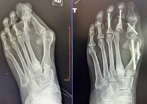 Bunion Surgery