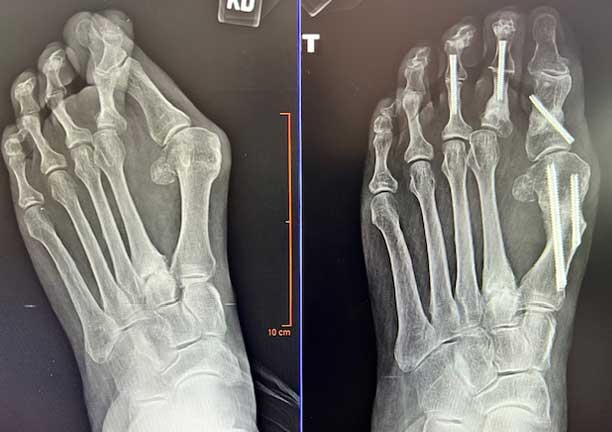 Bunion Surgery