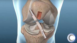 acl-graft