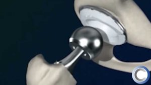 What Approach is Used for Hip Replacement Surgery?