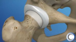 What is Hip Arthroscopy?