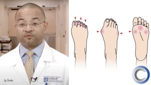 What are Bunions?